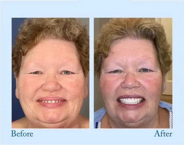 ๐๐ข๐๐จ๐ง๐ยฎ ๐๐ซ๐๐ฆ๐ข๐ฎ๐ฆ ๐๐๐ง๐ญ๐ฎ๐ซ๐