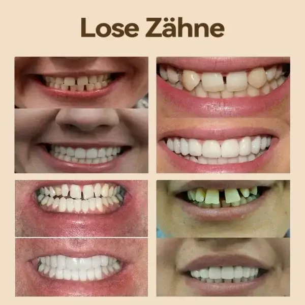 𝐇𝐢𝐝𝐨𝐧𝐞®🚀 – 🦷𝐏𝐫𝐞𝐦𝐢𝐮𝐦 𝐆𝐞𝐛𝐢𝐬𝐬🦷(✨Geeignet für alle Mundformen, speziell angefertigte Zahnersätze für die perfekte Passform✨)