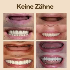 𝐇𝐢𝐝𝐨𝐧𝐞®🚀 – 🦷𝐏𝐫𝐞𝐦𝐢𝐮𝐦 𝐆𝐞𝐛𝐢𝐬𝐬🦷(✨Geeignet für alle Mundformen, speziell angefertigte Zahnersätze für die perfekte Passform✨)