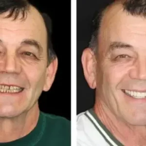 𝐁𝐢𝐤𝐞𝐧𝐝𝐚® –🦷Advanced Customized Full Denture Set🦷🇺🇸 (⏰Limited time discount last 30 minutes⏰)