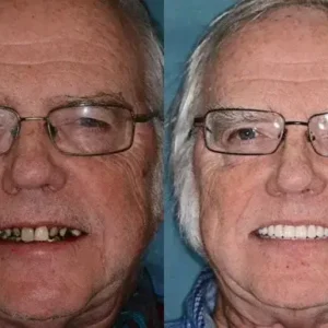 𝐁𝐢𝐤𝐞𝐧𝐝𝐚® –🦷Advanced Customized Full Denture Set🦷🇺🇸 (⏰Limited time discount last 30 minutes⏰)