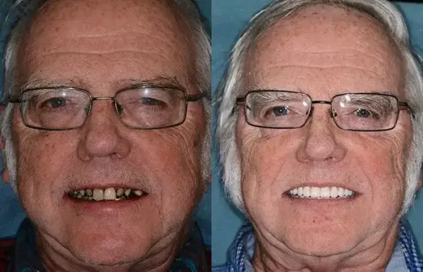 𝐁𝐢𝐤𝐞𝐧𝐝𝐚® –🦷Advanced Customized Full Denture Set🦷🇺🇸 (⏰Limited time discount last 30 minutes⏰)