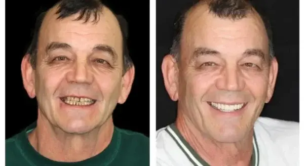 Hidone® Full Denture Set🦷🦷💃Advanced Self-Adjusting Dental Materials (⏰Limited time discount last 30 minutes⏰)