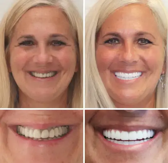 Hidone® Full Denture Set🦷🦷💃Advanced Self-Adjusting Dental Materials (⏰Limited time discount last 30 minutes⏰)