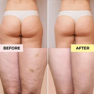 Slimoly Anti Cellulite Massage Oil - Skin Tightening, Moisturizing