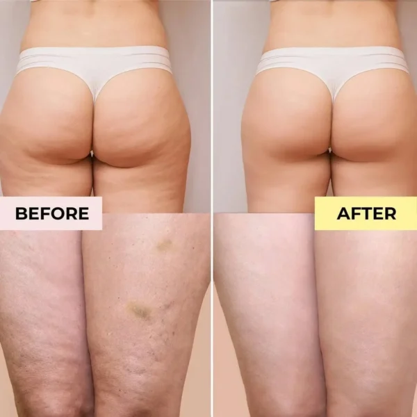 Slimoly Anti Cellulite Massage Oil - Skin Tightening, Moisturizing