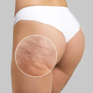 Slimoly Anti Cellulite Massage Oil - Skin Tightening, Moisturizing