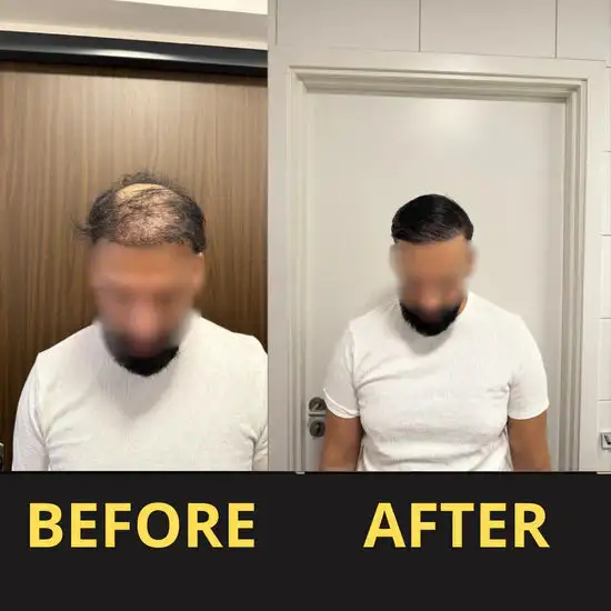 Slimoly™ Hair & Scalp Concealer 50ML - Waterproof 3–7 days.